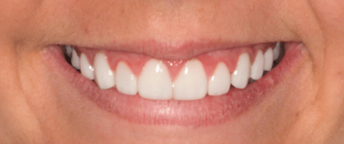 smile after veneers