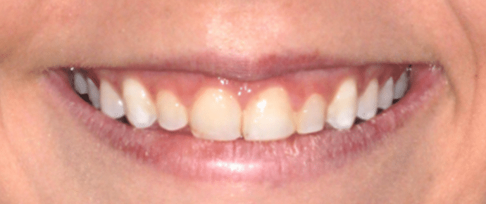 smile before veneers