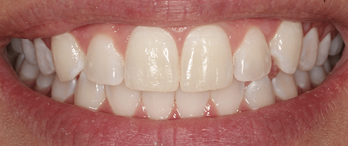 smile after crowns and veneers