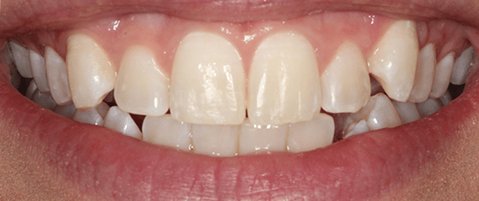 smile before crowns and veneers
