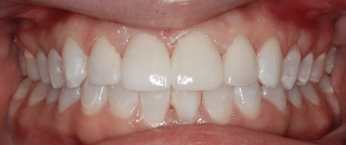 smile after veneers