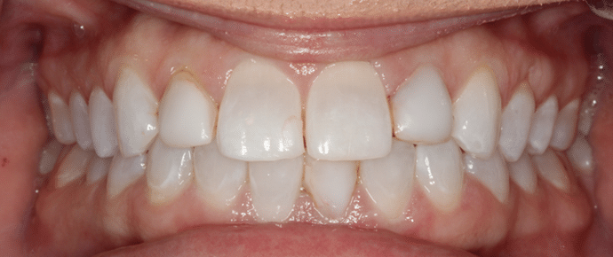 smile before veneers