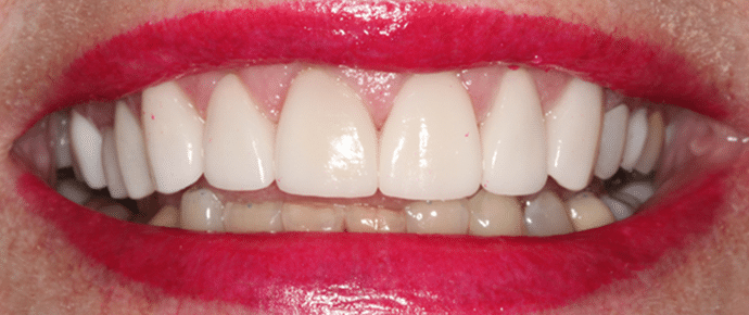 smile after crowns