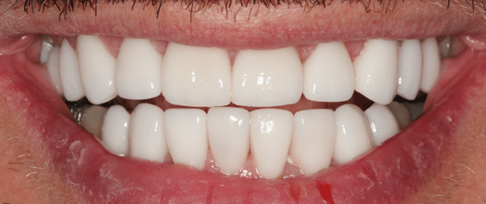 smile after crowns and veneers