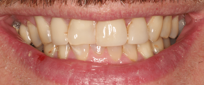 smile before crowns and veneers