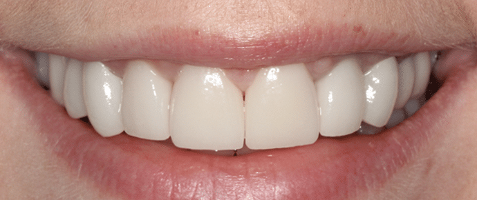 smile after crowns