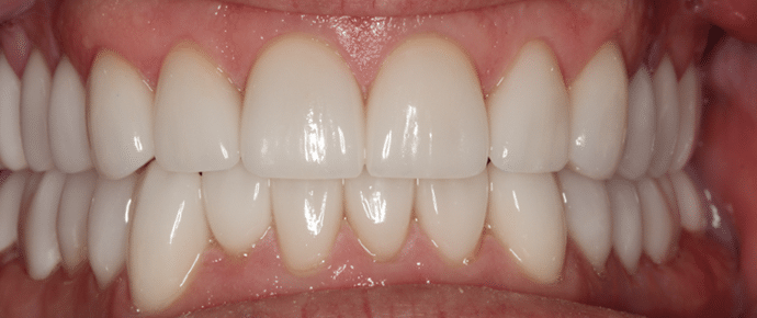 smile after crowns