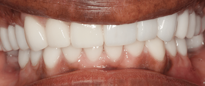smile after veneers