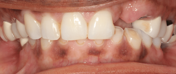 smile before veneers