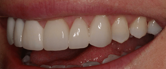 smile after veneers
