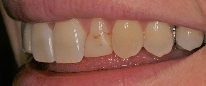 smile before veneers