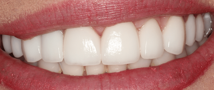 smile after veneers