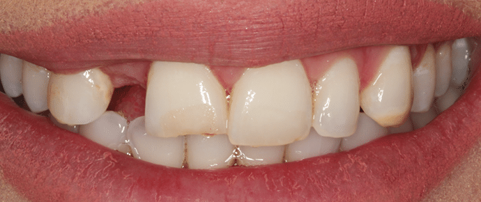 smile before veneers