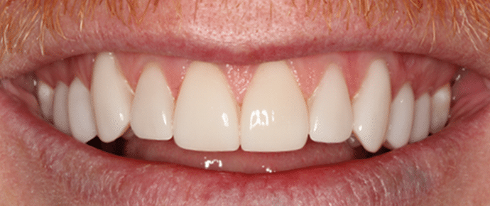 smile after veneers