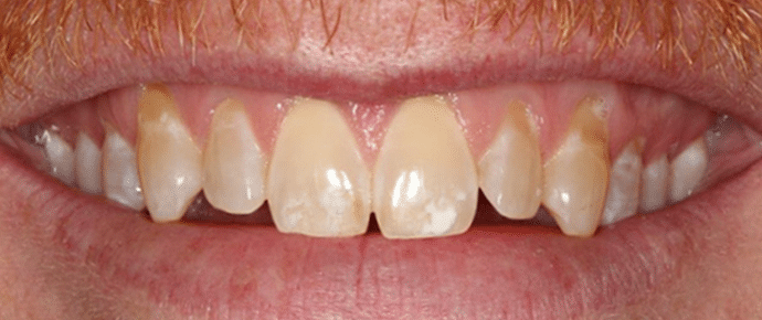 smile before veneers