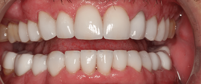 smile after crowns and veneers