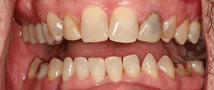 smile before crowns and veneers