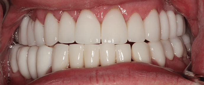 smile after crowns