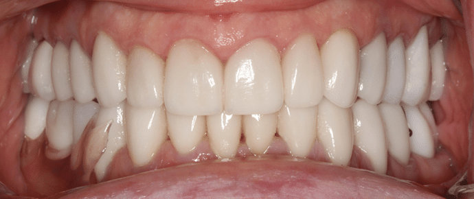 smile after crowns