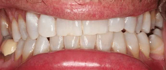 after whitening