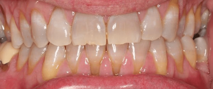before whitening