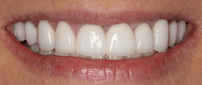 smile after crowns and veneers
