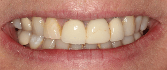 smile before crowns and veneers