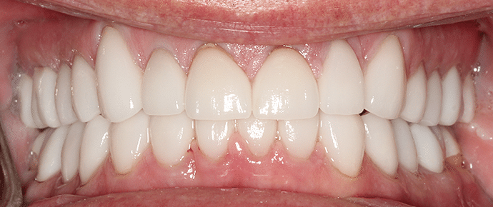 smile after crowns