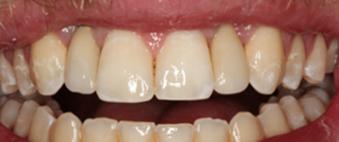 missing teeth - after