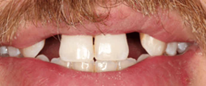 missing teeth - before