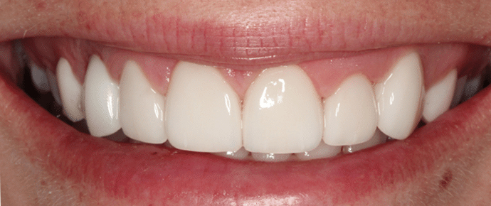 smile after veneers