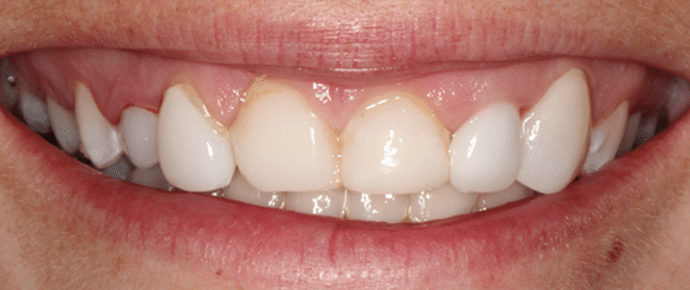smile before veneers