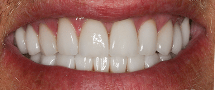 smile after veneers