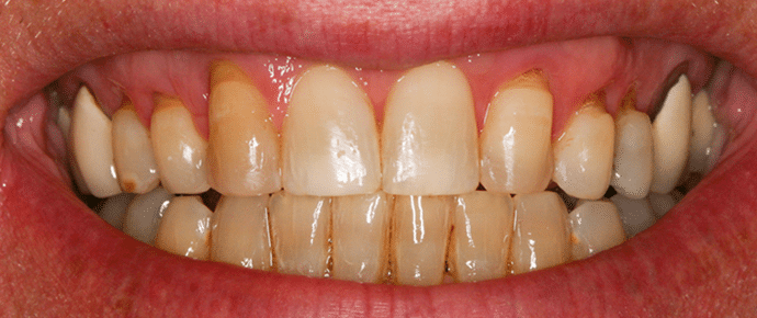 smile before veneers