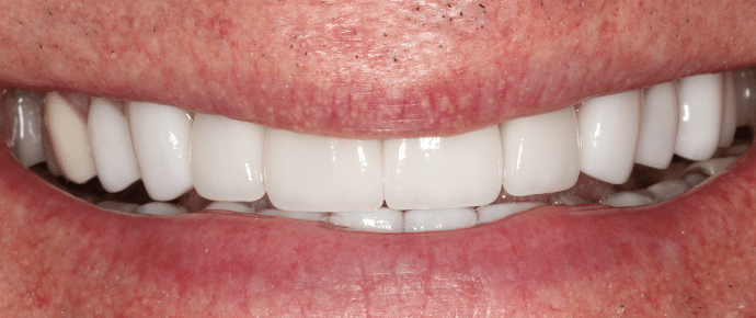 smile after crowns and veneers