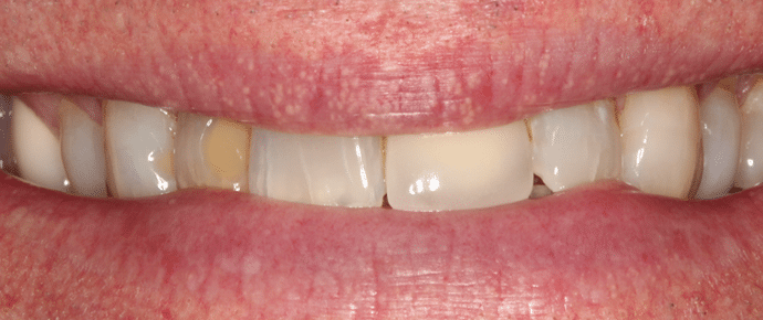 smile before crowns and veneers
