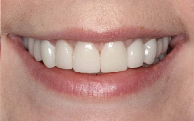 after Smile Makeover