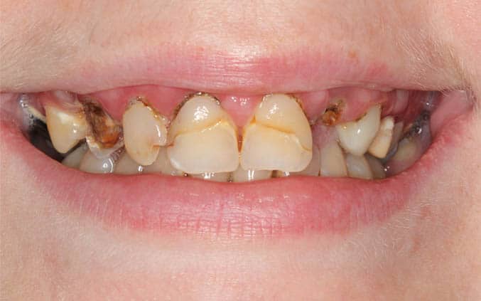 before Smile Makeover
