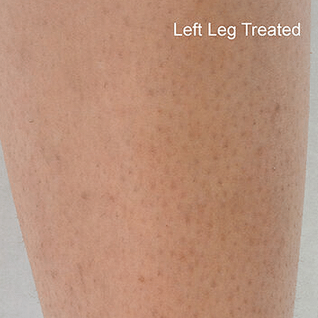 leg after DiolazeXL