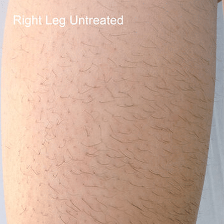 leg before DiolazeXL