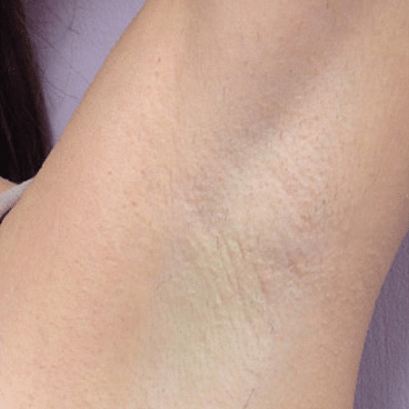 armpit after DiolazeXL