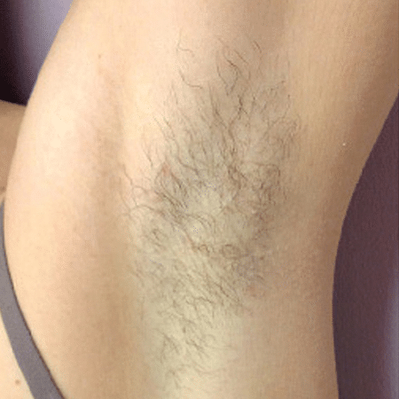 armpit before DiolazeXL