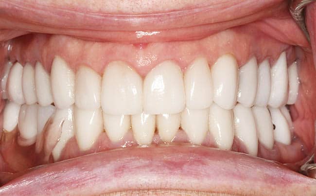 after Smile Makeover