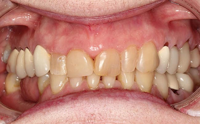 before Smile Makeover