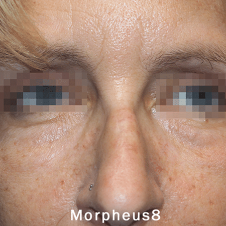 after Morpheus8